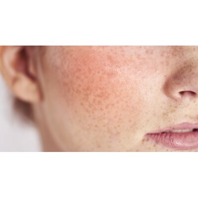 Nickelallergie: Wie wählt man Kosmetik aus? - Nickelallergie: Wie wählt man Kosmetik aus?