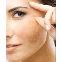 TRIDERM A.K. 50+ Preventive Care Sun Protection